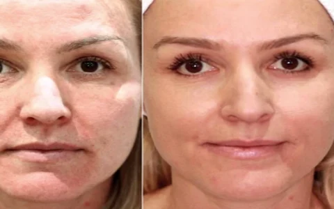 Antes e depois de Luiza, 47